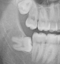impacted wisdom tooth 