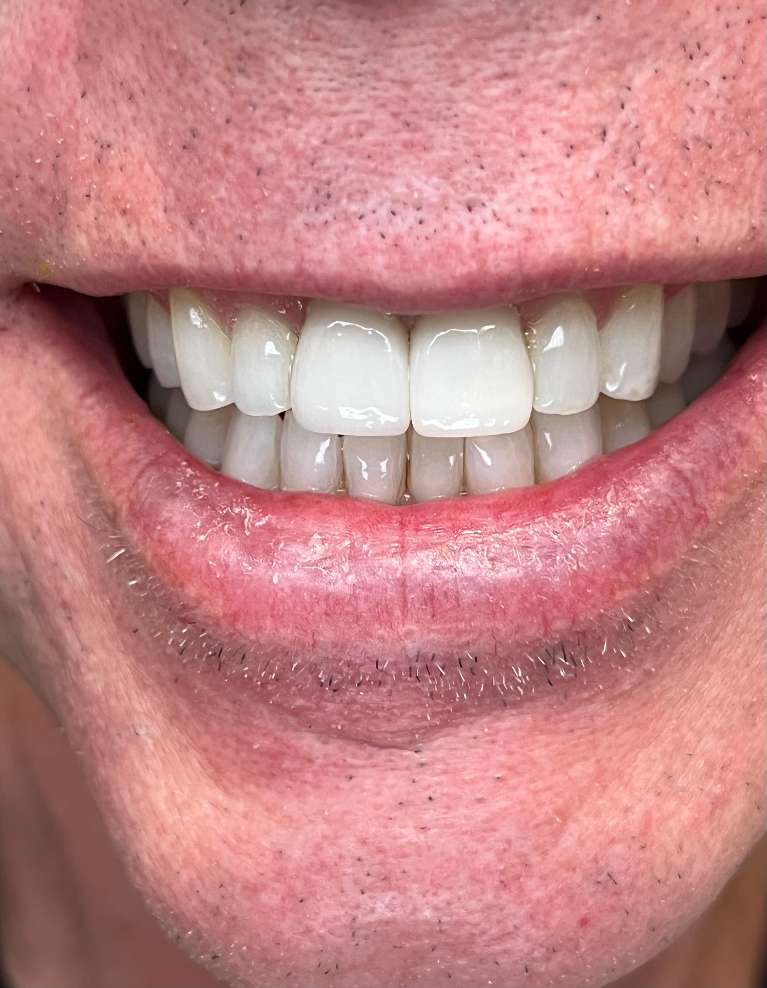 Replace-old-crowns-with-new-ones-to-match-the-natural-teeth-After-Image
