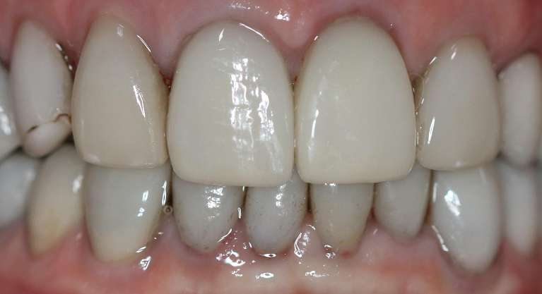 Replacement-of-cracked-and-stained-old-veneers-in-two-front-upper-teeth-After-Image