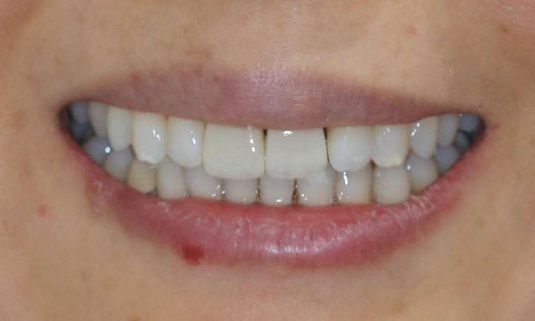 Minimally-invasive-and-conservative-teeth-alignment-with-Invisalign-and-single-veneer-After-Image