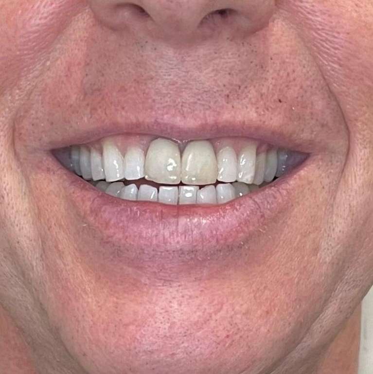 Replace-old-crowns-with-new-ones-to-match-the-natural-teeth-Before-Image