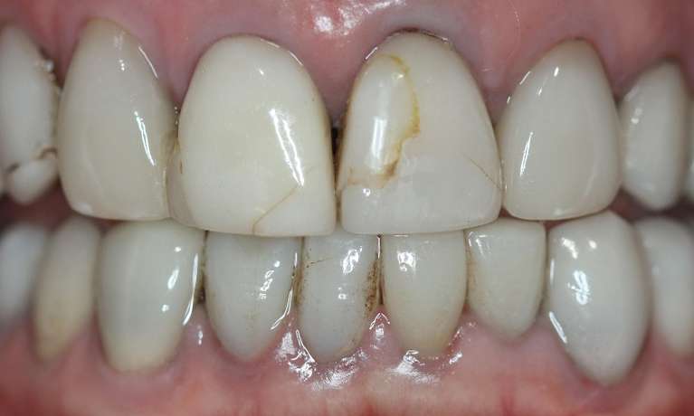 Replacement-of-cracked-and-stained-old-veneers-in-two-front-upper-teeth-Before-Image