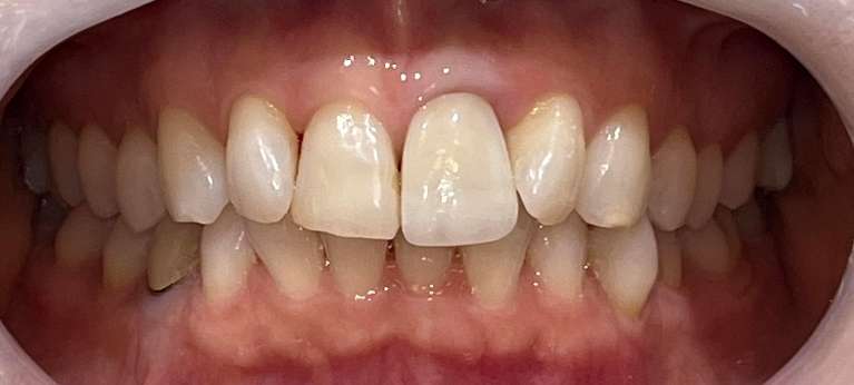 Minimally-invasive-and-conservative-teeth-alignment-with-Invisalign-and-single-veneer-Before-Image